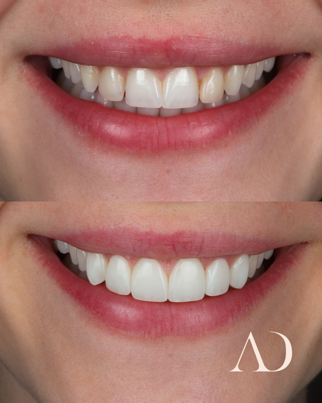 FINAL SMILE BEFORE&AFTER (1)