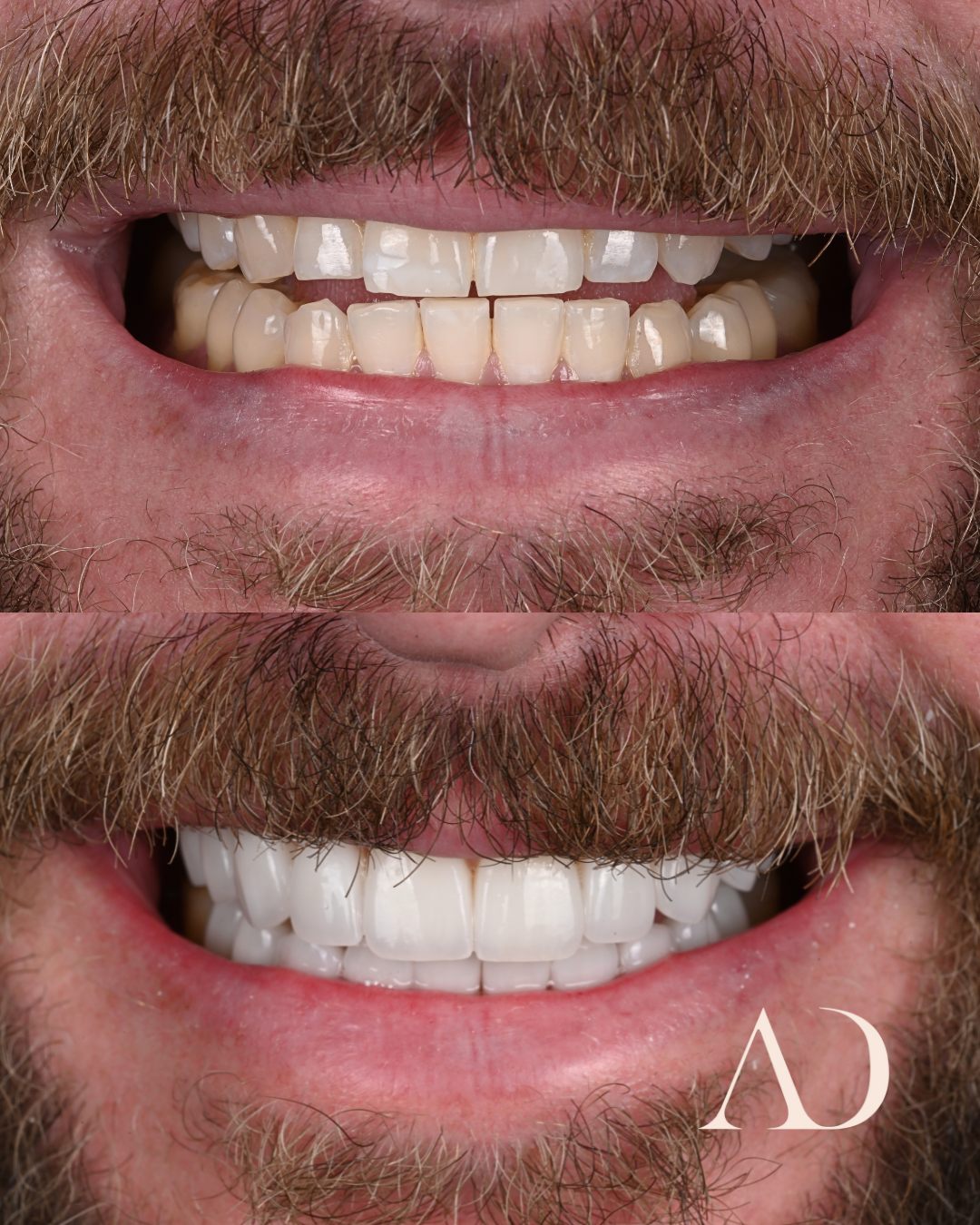 FINAL SMILE BEFORE&AFTER (6)