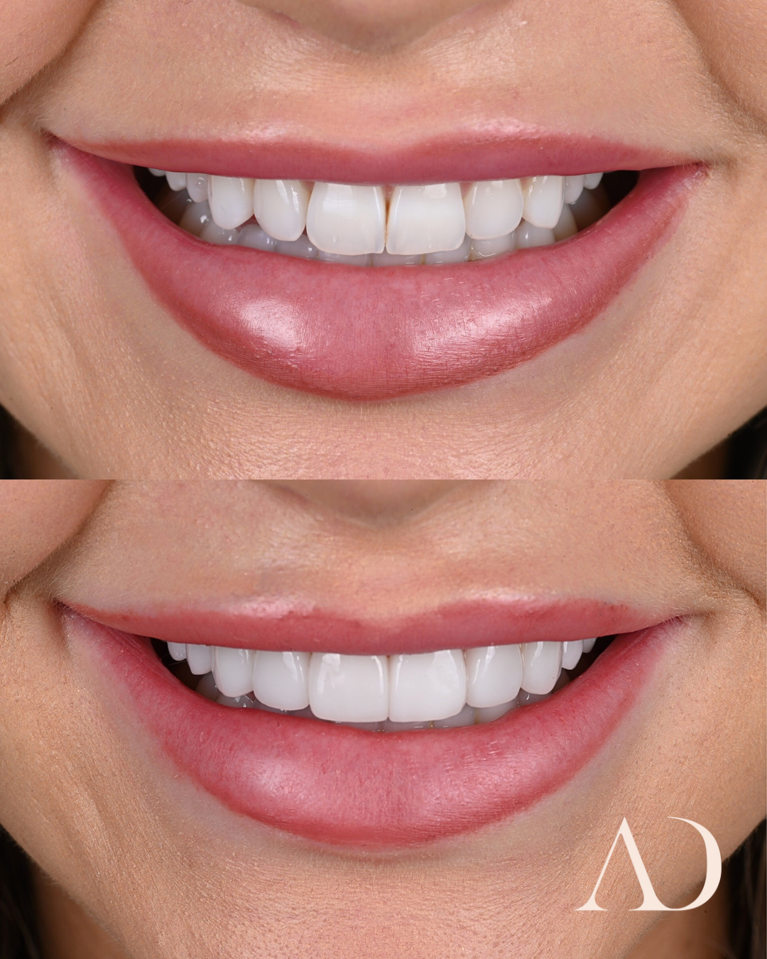 FINAL SMILE BEFORE&AFTER